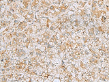 Immunohistochemistry of paraffin-embedded Human liver cancer tissue using FERMT1 Polyclonal Antibody at dilution of 1:30(×200)