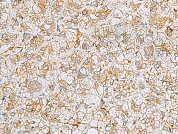 Immunohistochemistry of paraffin-embedded Human liver cancer tissue using FERMT1 Polyclonal Antibody at dilution of 1:30(×200)