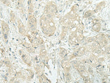 Immunohistochemistry of paraffin-embedded Human breast cancer tissue using MIEN1 Polyclonal Antibody at dilution of 1:45(×200)