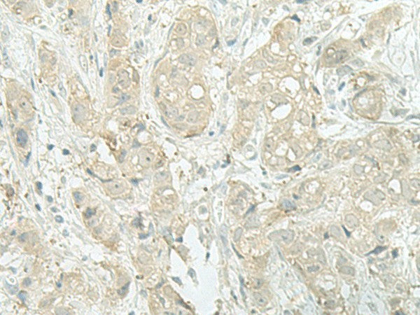 Immunohistochemistry of paraffin-embedded Human breast cancer tissue using MIEN1 Polyclonal Antibody at dilution of 1:45(×200)