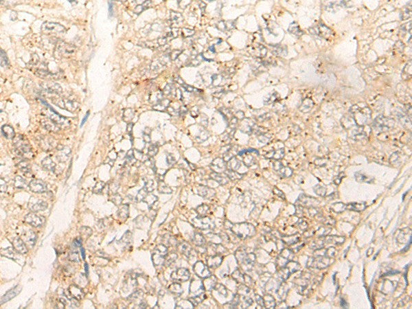 Immunohistochemistry of paraffin-embedded Human gastric cancer tissue using CUTA Polyclonal Antibody at dilution of 1:40(×200)