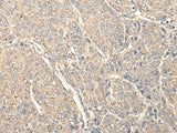 Immunohistochemistry of paraffin-embedded Human liver cancer tissue using C1orf106 Polyclonal Antibody at dilution of 1:80(×200)