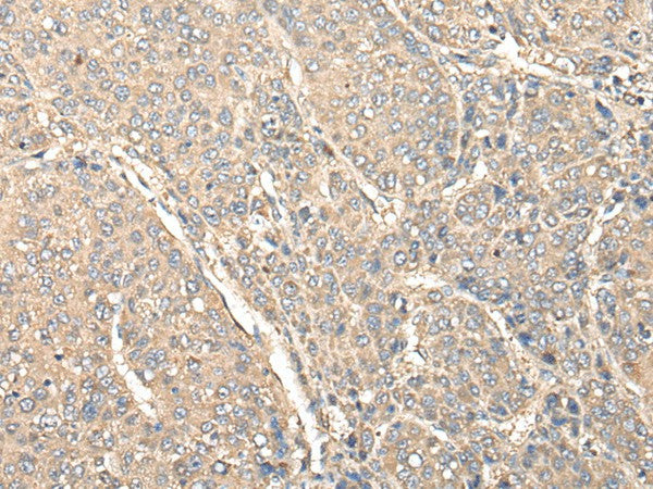 Immunohistochemistry of paraffin-embedded Human liver cancer tissue using C1orf106 Polyclonal Antibody at dilution of 1:80(×200)