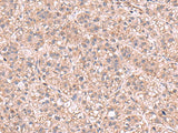 Immunohistochemistry of paraffin-embedded Human liver cancer tissue using KPNA2 Polyclonal Antibody at dilution of 1:60(×200)