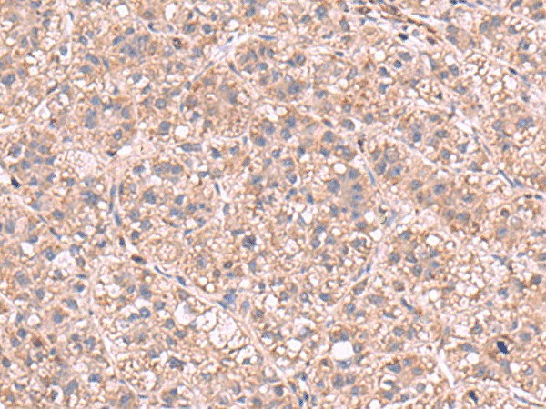 Immunohistochemistry of paraffin-embedded Human liver cancer tissue using KPNA2 Polyclonal Antibody at dilution of 1:60(×200)