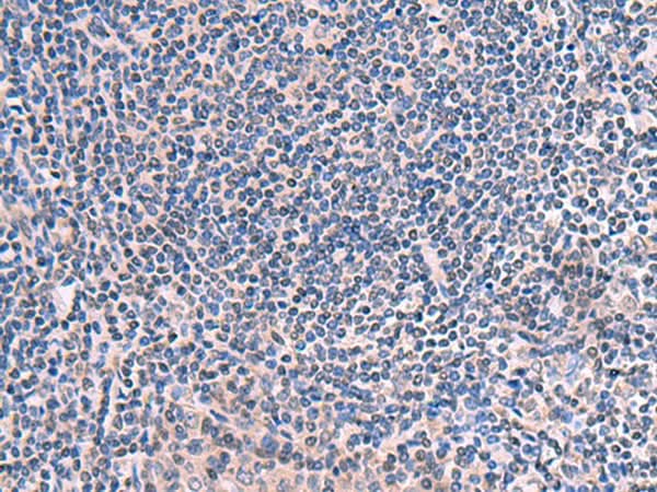 Immunohistochemistry of paraffin-embedded Human tonsil tissue using SCCPDH Polyclonal Antibody at dilution of 1:50(×200)