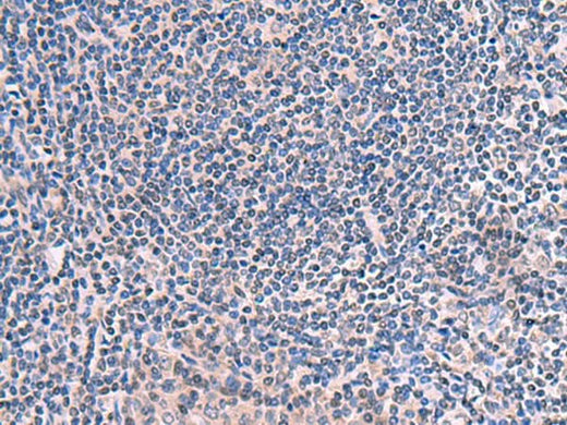 Immunohistochemistry of paraffin-embedded Human tonsil tissue using SCCPDH Polyclonal Antibody at dilution of 1:50(×200)