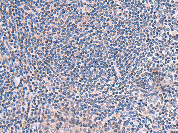 Immunohistochemistry of paraffin-embedded Human tonsil tissue using SCCPDH Polyclonal Antibody at dilution of 1:50(×200)