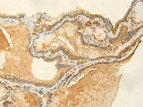 Immunohistochemistry of paraffin-embedded Human thyroid cancer tissue using RNF148 Polyclonal Antibody at dilution of 1:50(×200)