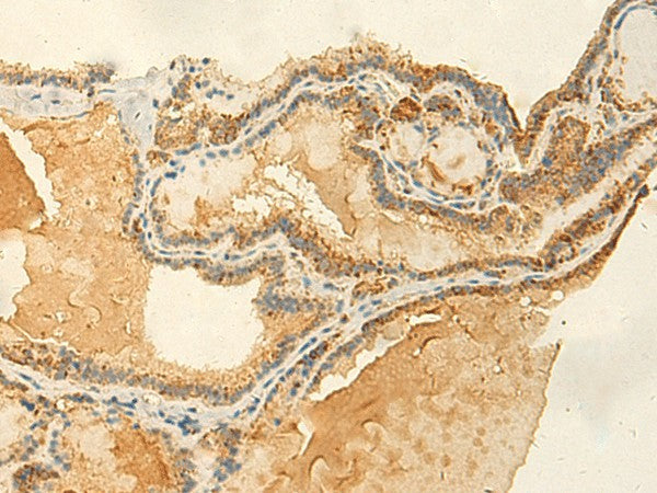 Immunohistochemistry of paraffin-embedded Human thyroid cancer tissue using RNF148 Polyclonal Antibody at dilution of 1:50(×200)