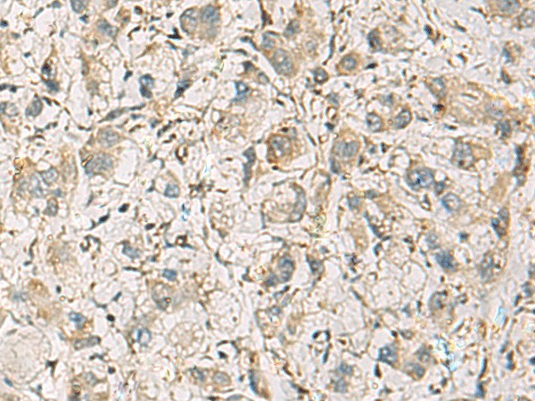 Immunohistochemistry of paraffin-embedded Human liver cancer tissue using CMTM1 Polyclonal Antibody at dilution of 1:40(×200)