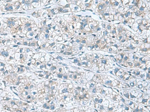 Immunohistochemistry of paraffin-embedded Human liver cancer tissue using GDF9 Polyclonal Antibody at dilution of 1:55(×200)