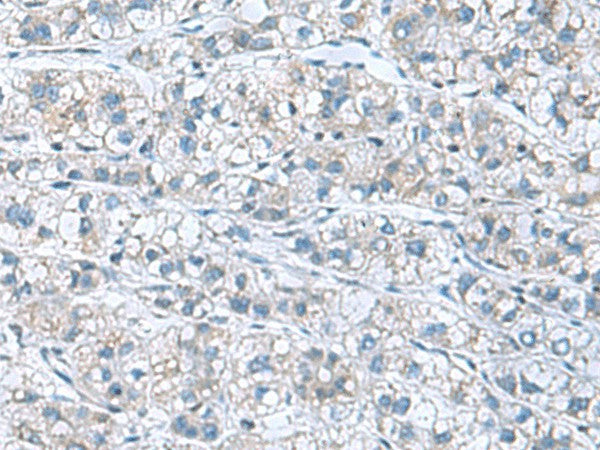 Immunohistochemistry of paraffin-embedded Human liver cancer tissue using GDF9 Polyclonal Antibody at dilution of 1:55(×200)