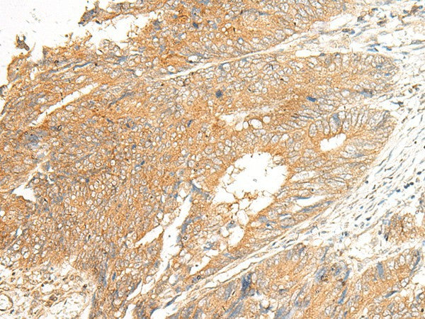 Immunohistochemistry of paraffin-embedded Human colorectal cancer tissue using C5AR2 Polyclonal Antibody at dilution of 1:25(×200)