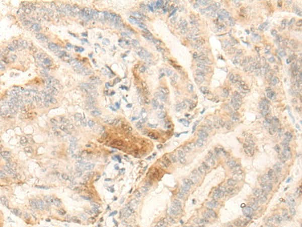 Immunohistochemistry of paraffin-embedded Human thyroid cancer tissue using BZW2 Polyclonal Antibody at dilution of 1:25(×200)