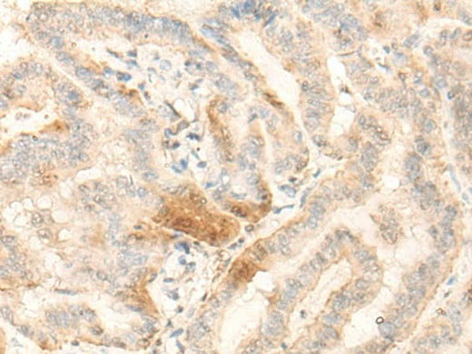 Immunohistochemistry of paraffin-embedded Human thyroid cancer tissue using BZW2 Polyclonal Antibody at dilution of 1:25(×200)