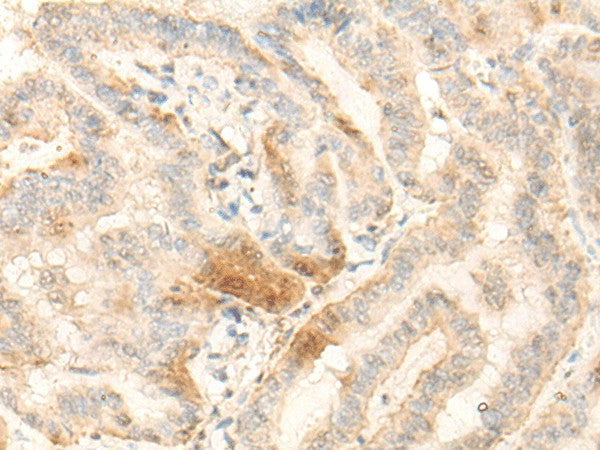 Immunohistochemistry of paraffin-embedded Human thyroid cancer tissue using BZW2 Polyclonal Antibody at dilution of 1:25(×200)