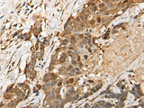Immunohistochemistry of paraffin-embedded Human thyroid cancer tissue using HEATR9 Polyclonal Antibody at dilution of 1:110(×200)