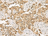 Immunohistochemistry of paraffin-embedded Human ovarian cancer tissue using LRIF1 Polyclonal Antibody at dilution of 1:70(×200)