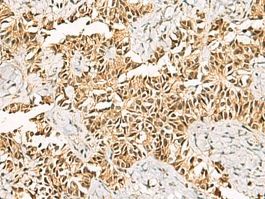 Immunohistochemistry of paraffin-embedded Human ovarian cancer tissue using LRIF1 Polyclonal Antibody at dilution of 1:70(×200)