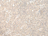 Immunohistochemistry of paraffin-embedded Human ovarian cancer tissue using HENMT1 Polyclonal Antibody at dilution of 1:35(×200)