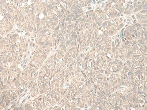 Immunohistochemistry of paraffin-embedded Human ovarian cancer tissue using HENMT1 Polyclonal Antibody at dilution of 1:35(×200)