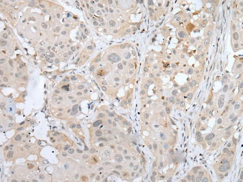 Immunohistochemistry of paraffin-embedded Human esophagus cancer tissue using BORCS8 Polyclonal Antibody at dilution of 1:50(×200)