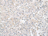 Immunohistochemistry of paraffin-embedded Human liver cancer tissue using FXYD6 Polyclonal Antibody at dilution of 1:65(×200)