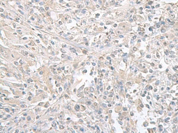 Immunohistochemistry of paraffin-embedded Human liver cancer tissue using FXYD6 Polyclonal Antibody at dilution of 1:65(×200)