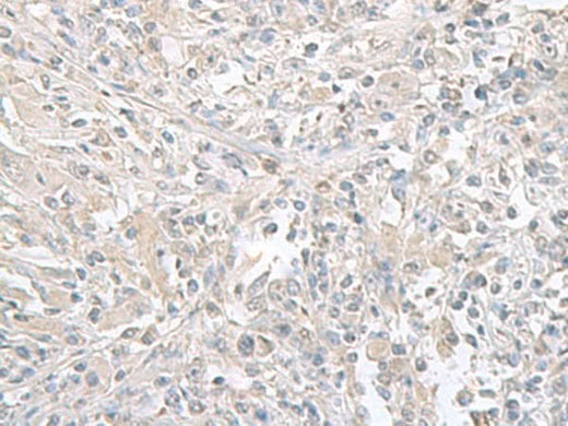 Immunohistochemistry of paraffin-embedded Human liver cancer tissue using FXYD6 Polyclonal Antibody at dilution of 1:65(×200)