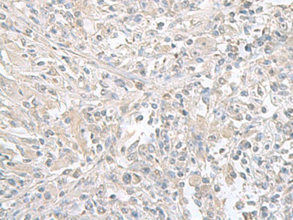 Immunohistochemistry of paraffin-embedded Human liver cancer tissue using FXYD6 Polyclonal Antibody at dilution of 1:65(×200)
