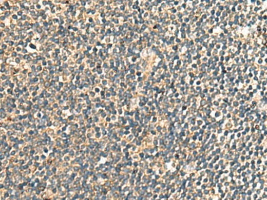 Immunohistochemistry of paraffin-embedded Human tonsil tissue using PRKRA Polyclonal Antibody at dilution of 1:60(×200)