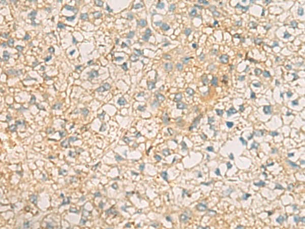 Immunohistochemistry of paraffin-embedded Human liver cancer tissue using MRPL9 Polyclonal Antibody at dilution of 1:60(×200)