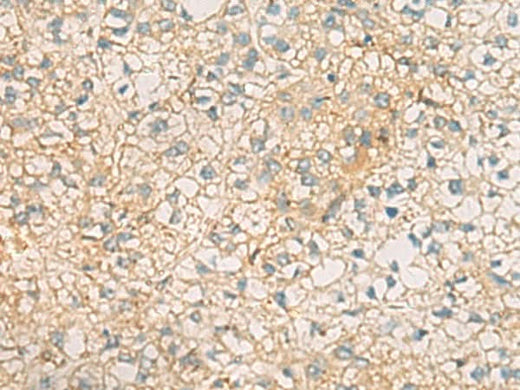 Immunohistochemistry of paraffin-embedded Human liver cancer tissue using MRPL9 Polyclonal Antibody at dilution of 1:60(×200)