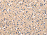 Immunohistochemistry of paraffin-embedded Human liver cancer tissue using ZNF268 Polyclonal Antibody at dilution of 1:50(×200)