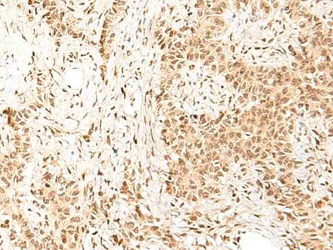 Immunohistochemistry of paraffin-embedded Human ovarian cancer tissue using HIST1H1D Polyclonal Antibody at dilution of 1:55(×200)
