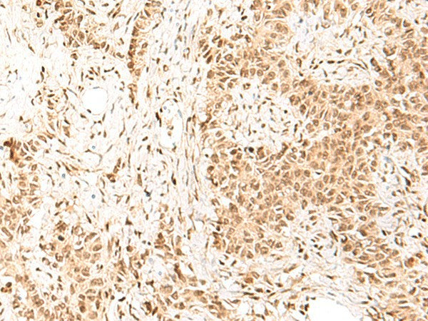 Immunohistochemistry of paraffin-embedded Human ovarian cancer tissue using HIST1H1D Polyclonal Antibody at dilution of 1:55(×200)