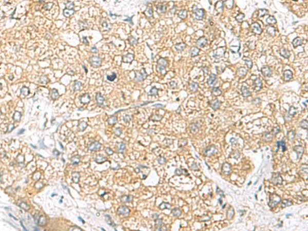 Immunohistochemistry of paraffin-embedded Human liver cancer tissue using SH3GL2 Polyclonal Antibody at dilution of 1:45(×200)