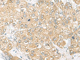 Immunohistochemistry of paraffin-embedded Human liver cancer tissue using SH3GL2 Polyclonal Antibody at dilution of 1:45(×200)