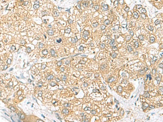 Immunohistochemistry of paraffin-embedded Human liver cancer tissue using SH3GL2 Polyclonal Antibody at dilution of 1:45(×200)