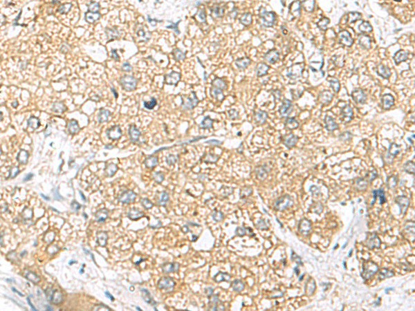 Immunohistochemistry of paraffin-embedded Human liver cancer tissue using SH3GL2 Polyclonal Antibody at dilution of 1:45(×200)