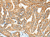 Immunohistochemistry of paraffin-embedded Human thyroid cancer tissue using C1R Polyclonal Antibody at dilution of 1:70(×200)