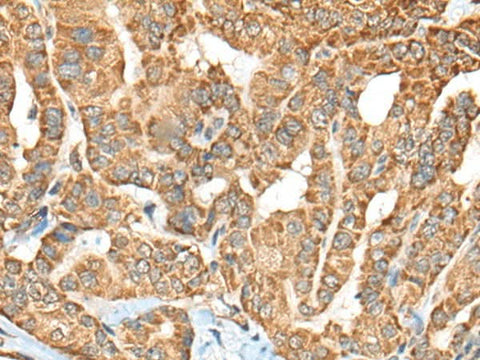 Immunohistochemistry of paraffin-embedded Human thyroid cancer tissue using C1R Polyclonal Antibody at dilution of 1:70(×200)