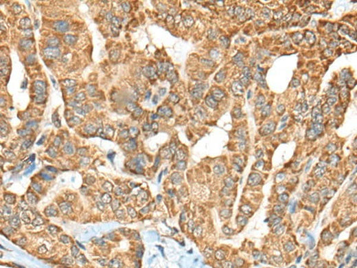 Immunohistochemistry of paraffin-embedded Human thyroid cancer tissue using C1R Polyclonal Antibody at dilution of 1:70(×200)