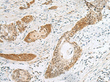 Immunohistochemistry of paraffin-embedded Human esophagus cancer tissue using HIST1H2BK Polyclonal Antibody at dilution of 1:40(×200)