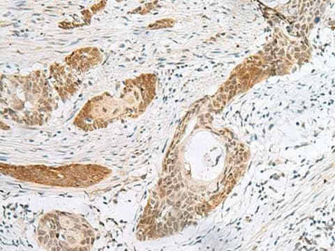 Immunohistochemistry of paraffin-embedded Human esophagus cancer tissue using HIST1H2BK Polyclonal Antibody at dilution of 1:40(×200)