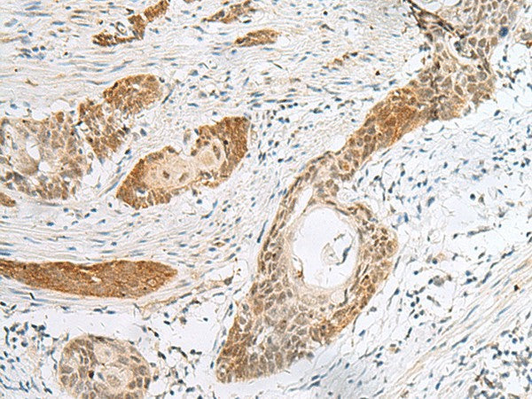 Immunohistochemistry of paraffin-embedded Human esophagus cancer tissue using HIST1H2BK Polyclonal Antibody at dilution of 1:40(×200)