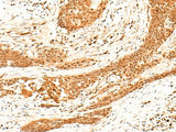 Immunohistochemistry of paraffin-embedded Human esophagus cancer tissue using HNF4A Polyclonal Antibody at dilution of 1:40(×200)
