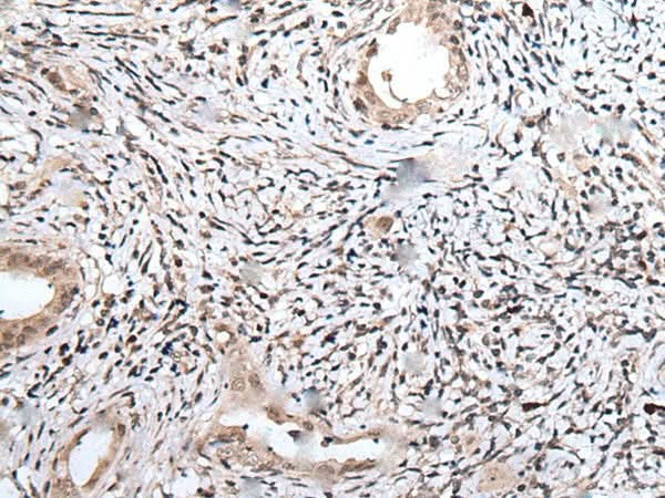 Immunohistochemistry of paraffin-embedded Human cervical cancer tissue using UBN1 Polyclonal Antibody at dilution of 1:75(×200)