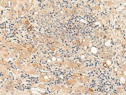 Immunohistochemistry of paraffin-embedded Human liver cancer tissue using SULT4A1 Polyclonal Antibody at dilution of 1:50(×200)